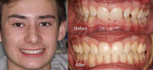 Smile Makeover before and after image
