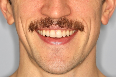 Image of Man's Teeth after Invisalign
