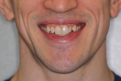 Image of Man's Teeth before Invisalign