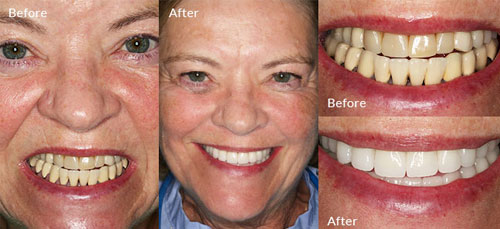 Smile Makeover before and after image