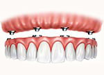 Implant-Supported Dentures