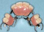 Partial Dentures