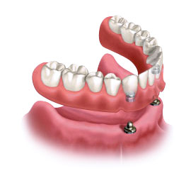 Denture Stabilization