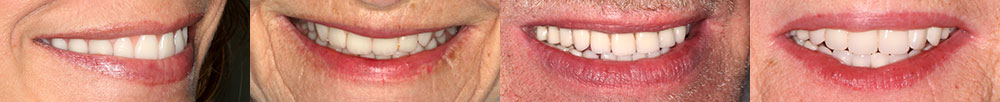 These patients all had their smiles restored with Rejuvenating Dentures.