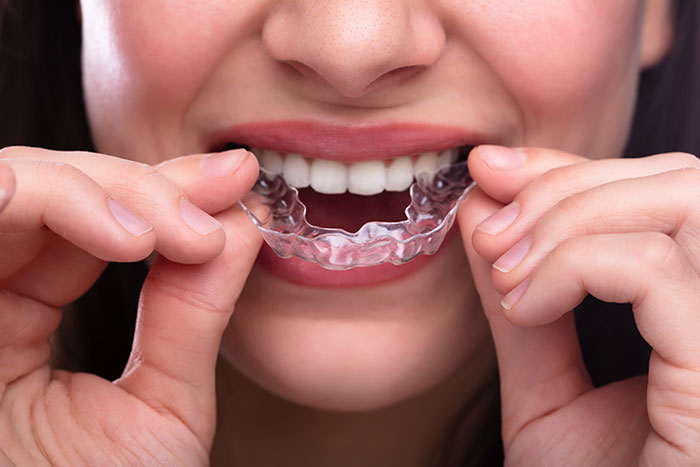 What are Invisalign Braces