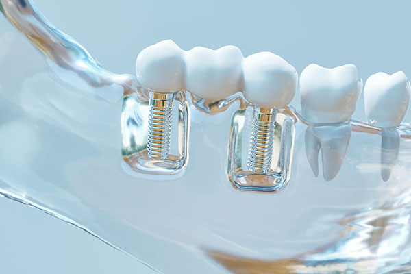 Jaw and Gum Resorption, Brush & Floss Dental Center
