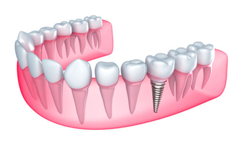 An image of a dental implant at Brush & Floss Dental Center in Stratford, CT.