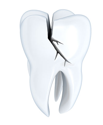 Types of Cracked Teeth