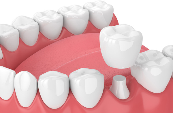 Photo of dental crown from Brush & Floss Dental Center in Stratford, CT