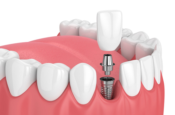 Photo of dental implants Brush & Floss Dental Center in Stratford, CT