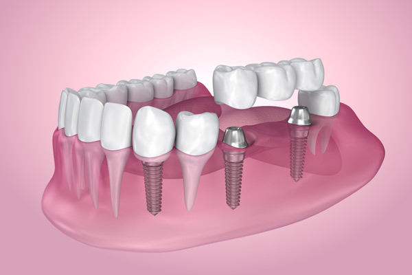 3D rendering of mouth with multiple dental implants at Brush & Floss Dental Center in Stratford, CT
