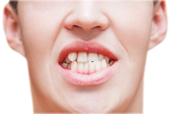 boy with crooked teeth