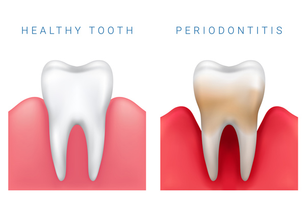 Photo of gum disease and healthy tooth Brush & Floss Dental Center in Stratford, CT