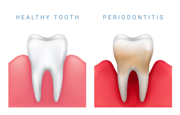 Regular Cleaning vs Periodontal Maintenance