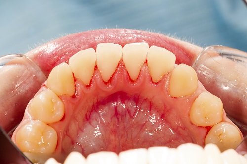 Common Signs of Periodontal Disease